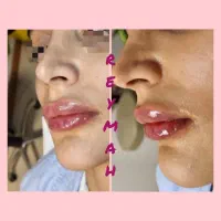 جشنواره فیلر،بوتاکس،اندولیفت،لاغری