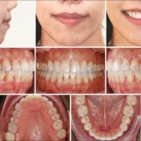 ارتودنسی شفاف(الاینر)لبخندزیبابدون سیم وبراکت