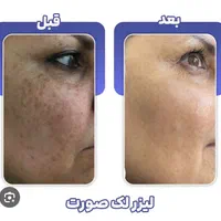حذف انواع ککومک لک ملاسما و تیرگی در یک جلسه
