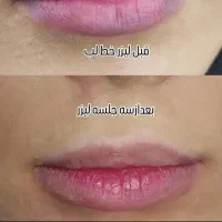 جشنواره لیزر ریمو تتو ابرو وبدن در مطب پزشک|خدمات آرایشگری و زیبایی|قم, بلوار امین و ساحلی|دیوار