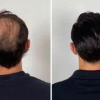 کاشت  مو برا چی تا وقتی کندش هست