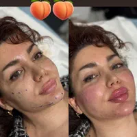 ژل و فیلر صورت و بدن|خدمات آرایشگری و زیبایی|اصفهان, ملک|دیوار