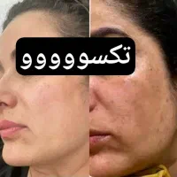 باتکسو زیبا شو اونم بدون عوارض وتضمینی|آرایشی، بهداشتی، درمانی|مشهد, شهرک ابوذر|دیوار