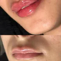 ژل،بوتاکس، لیزرخال و تاتو،ریمور|خدمات آرایشگری و زیبایی|قم, نیروگاه|دیوار