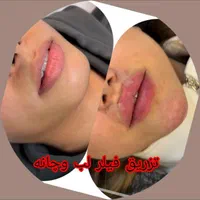 ساکشن غبغب وشکم. کاشت ابرو .|خدمات آرایشگری و زیبایی|پرند, |دیوار