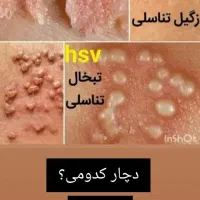 ازبین برندن زگیل تناسلی درکمتراز۱۵روزوبهبودی کامل|خدمات آرایشگری و زیبایی|گرگان, |دیوار