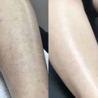 لیزر(۲جلسه رایگان)جلسات بعدی فول بادی(۴۰۰تومان)