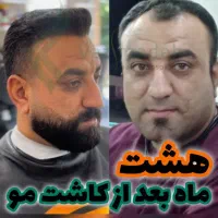 کاشت مو شیراز وزیرزاده