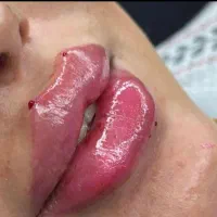 ژل وبوتاکس نخ فیلربادی توسط پزشک|خدمات آرایشگری و زیبایی|تهران, جمهوری|دیوار