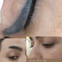 ریموو تتو در کلینیک