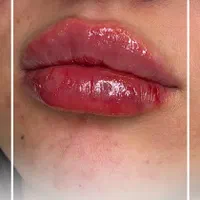 فیلر لب توسط پزشک متخصص لب روسی