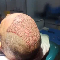 جشنواره پاییز کاشت مو طبیعی با تخفیف|خدمات آرایشگری و زیبایی|اهواز, کیانپارس |دیوار