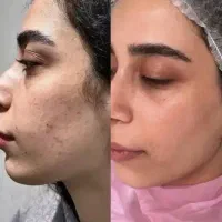 پاکسازی صورت و درمان پوست توسط پرستار خانم