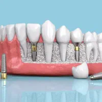 ایمپلنت مهر شفاء|خدمات آرایشگری و زیبایی|قم, حنیف نژاد|دیوار