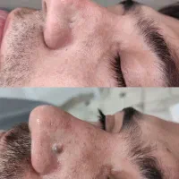 آموزش خال برداری /پلکسر/لیزر زگیل/میکرونیدلینگ