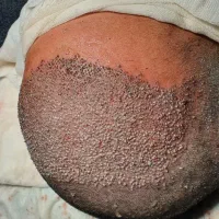 کاشت مو و ابرو حرفه‌ای