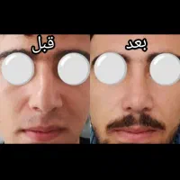 عمل زیبایی بینی|خدمات آرایشگری و زیبایی|زنجان, |دیوار