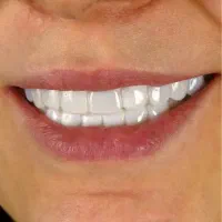 اسنپ اسمایل/لمینت متحرک/زیبایی/دندانسازی/دندانپزشک