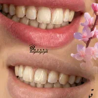 تخصصیVIP شیدینگ لب میکروبلیدینگ فیبروز ابرو خط چشم