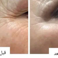 جدیدترین روش جوانسازی و رفع چروک