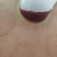 بادکش گرم وسرد وحجامت