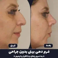 60%تخفیف لیفت صورت.وانجام لیفت بایشترین تعدادنخ|خدمات آرایشگری و زیبایی|مشهد, نیروی هوایی|دیوار