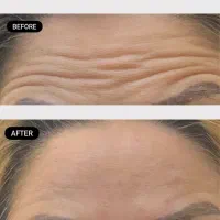 بوتاکس نچرال هالیوودی مصپورت