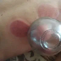 حجامت و بادکشی در منزل