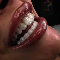 مدل کامپوزیت لیرینگ