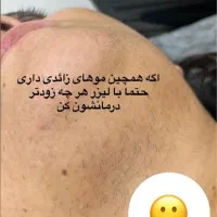 لیزرموهای زائد ویژه بانوان|خدمات آرایشگری و زیبایی|مشهد, توس (بلوار توس)|دیوار