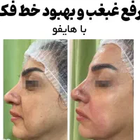 هایفوتراپی رفع چین و چروک پوست با بروزترین تجهیزات|خدمات آرایشگری و زیبایی|شیراز, قدوسی غربی|دیوار