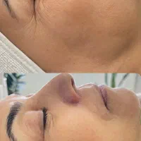 فیشیال تخصصی و درمانی پوست