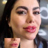 کلینیک ژل بوتاکس هر پک 1 سی سی رایگان