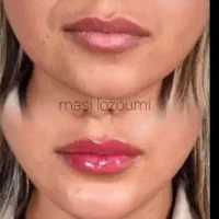 مرکز تخصصی ژل و بوتاکس در قزوین|خدمات آرایشگری و زیبایی|قزوین, |دیوار