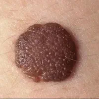 زگیل تناسلی hpv/تبخال تناسلی hsv/میخچه.زائده گوشتی