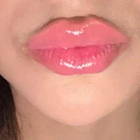 تزریق ژل بوتاکس فیلرصورت و بیکینی در مطب زیبایی|خدمات آرایشگری و زیبایی|تبریز, |دیوار