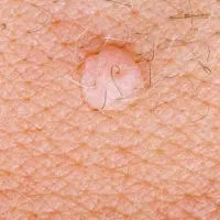 بهبودقطعی وریشه ای زگیل و تبخال تناسلی