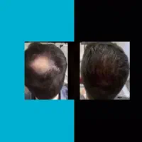 مو های کم پشتت رو احیا کن