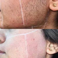 لیزر موهای زائد