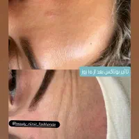 تخفیفات آنزیم بوتاکس صورت فیلر فول فیس و...|خدمات آرایشگری و زیبایی|مشهد, شهید فرامرز عباسی|دیوار