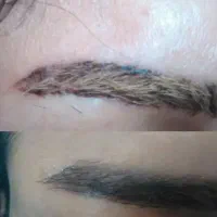 پاک کردن تخصصی تاتو