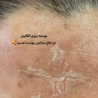 درمان تخصصی پوست لک کک و مک صورت پاکسازی فیشیال