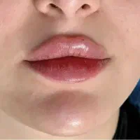 ژل و بوتاکس با تخفیف ویژه