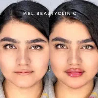 ژل مادلینگ صورت بوتاکس مزوتراپی فیلربادی prp فشیال