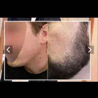رویش ریش تضمینی