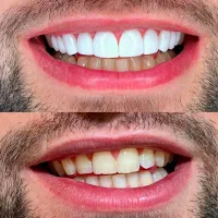 خدمات کامپوزیت دندان با اقساط آسان|خدمات آرایشگری و زیبایی|قم, صفائیه|دیوار