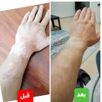 درمان دائمی بیماری پیسی وپسوریازیس واگزما|خدمات آرایشگری و زیبایی|امیدیه, |دیوار
