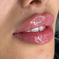 تزریق فیلر و بوتاکس700مزو ژل لب گونه فول فیس زاویه