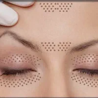 پلاسماجت و مزونیدلینگ جلسه ایی ۴۰۰