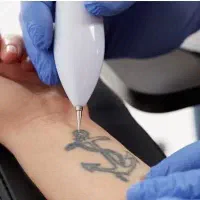 لیزر تتو( پاک شدن داعمی جوهر تتو و خالکوبی)